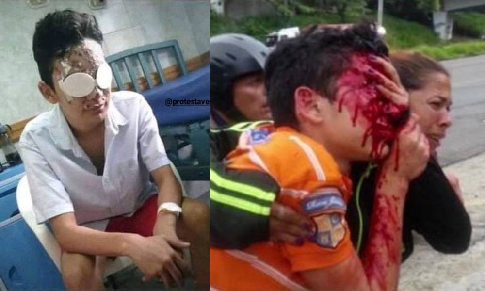 （慎入）委內瑞拉16歲示威者眼部中16發橡膠子彈致盲 警官終被控「謀殺未遂」
