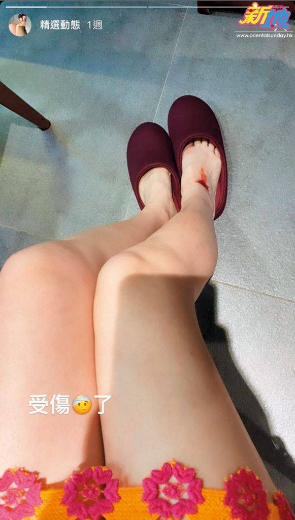 當日受傷後，甄詠珊在IG Story放出腳部受傷和到診所治理傷口的照片，照片清楚可見傷口深而長。