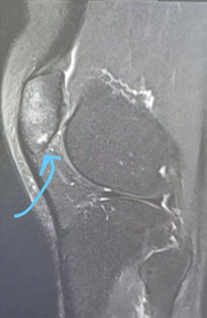 X光圖片顯示阿Mag膝頭哥底真係有輕微骨裂。（圖片來源：林欣彤IG）