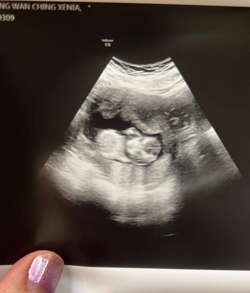 上月莊韻澄上載BB超聲波相宣佈懷第二胎，不料傳來令人心痛的消息。