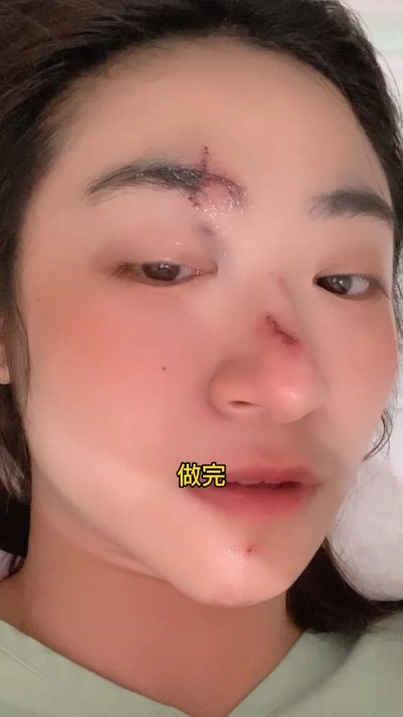 j2女神 黃紫恩 黃紫恩完成手術，她稱不擔心留疤。