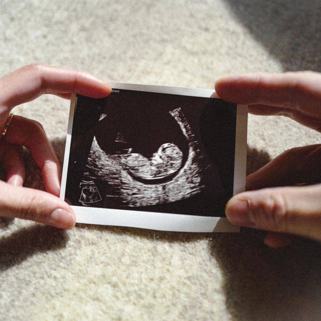 袁偉豪 張寶兒 張寶兒在社文網晒出BB的超聲波照片。