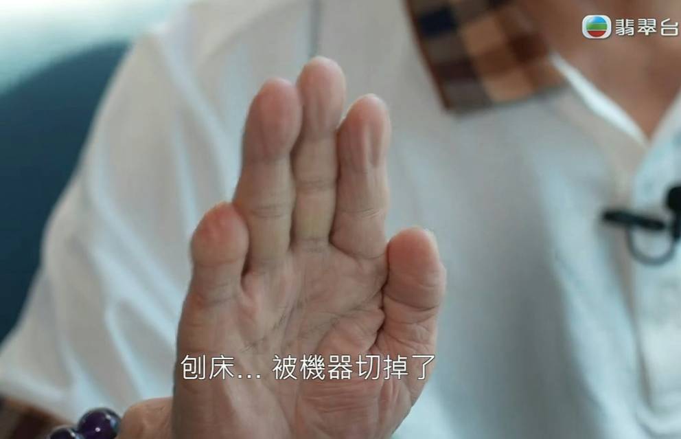 东张西望 何伯 他表示是因为在从事工程工作时不小心被机器切断（图片来源：TVB）