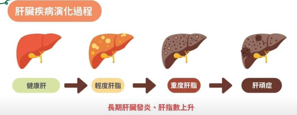 周奕瑋 重度肝脂 肝脂會根據肝臟中脂肪累積的程度可分為三個級別:輕度、中度和重度。(「周奕瑋JARvelogue」影片截圖)