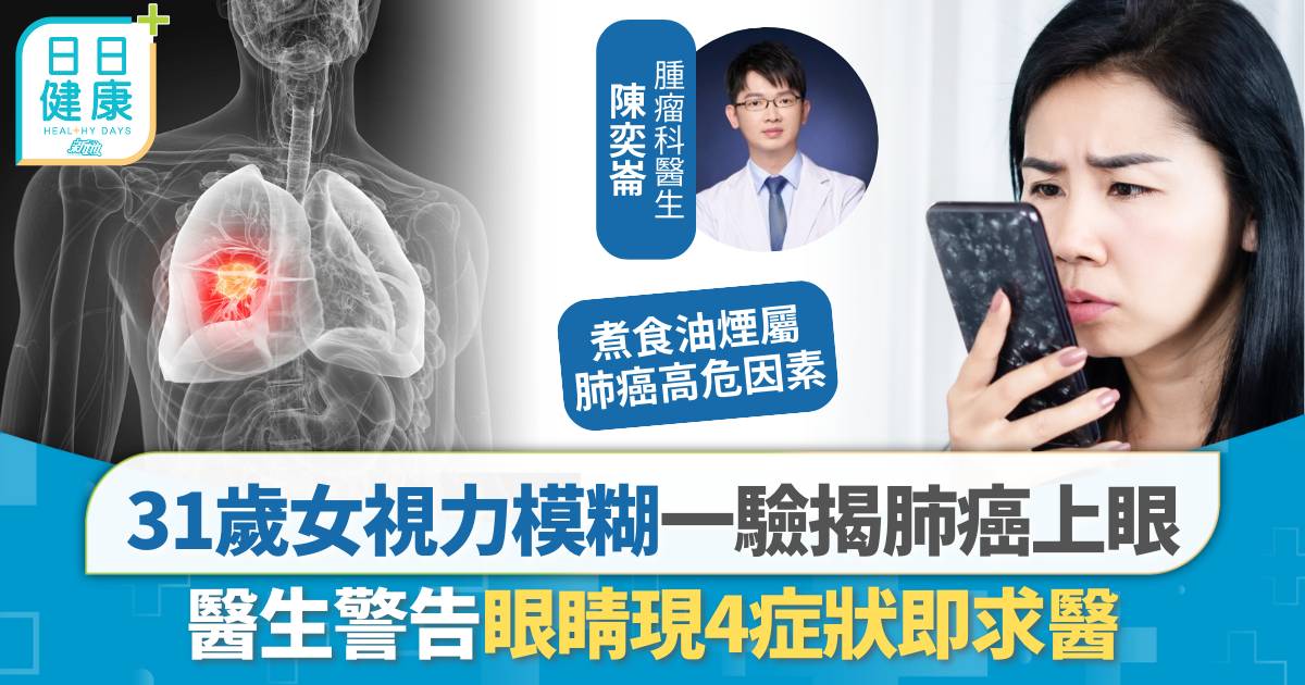 31歲女視力模糊一驗揭肺癌上眼 醫生警告眼睛現4症狀即求醫