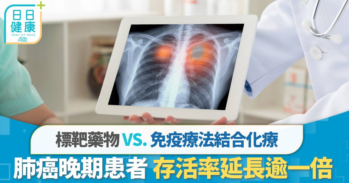 肺癌｜中大研究： 標靶治療延長肺癌晚期患者存活期逾一倍