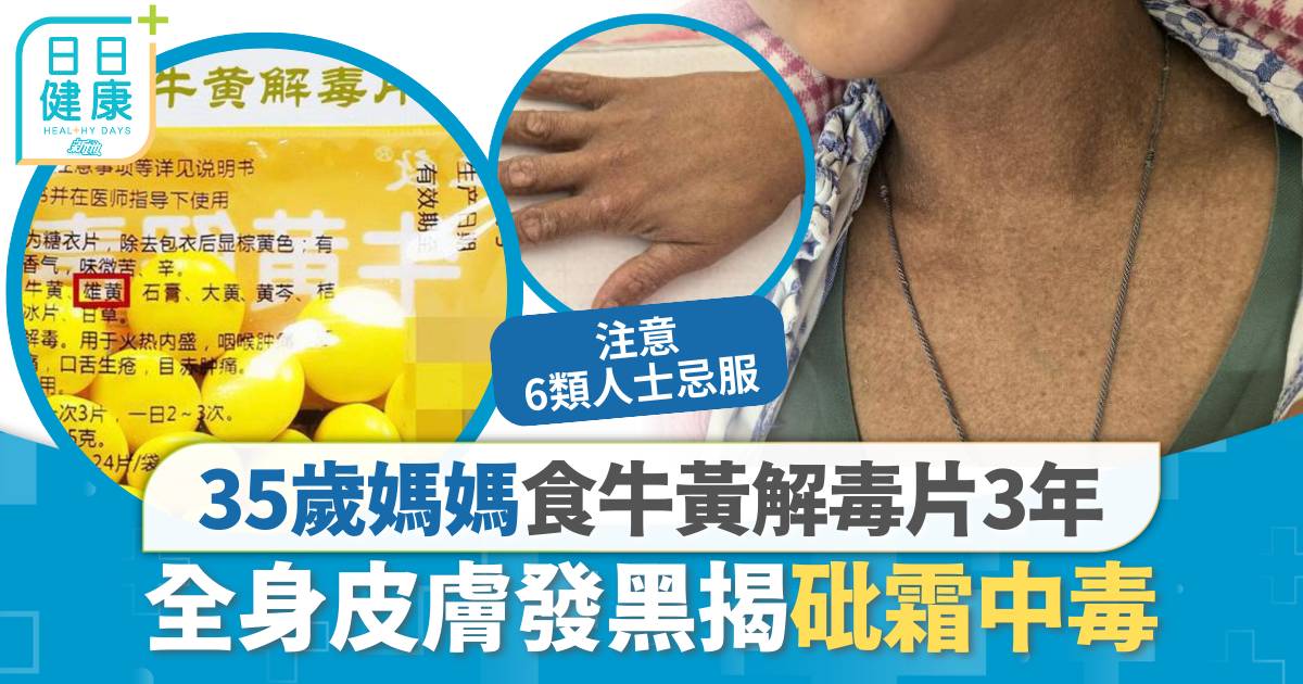 砒霜中毒｜35歲媽媽食牛黃解毒片3年 全身發黑揭慢性砷中毒 注意6類人士忌服