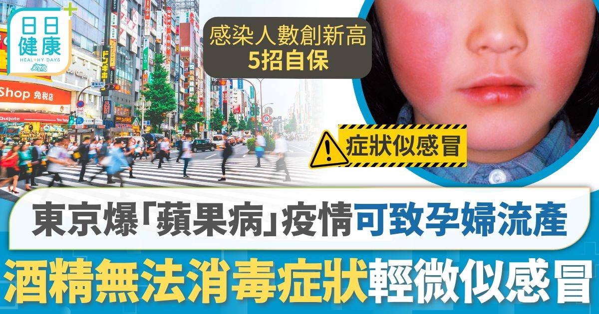 東京爆發「蘋果病」疫情 孕婦感染可致胎兒死亡 酒精無法消毒建議5招自保