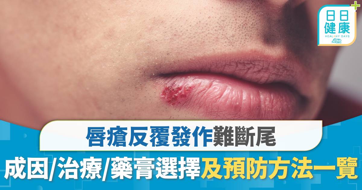 唇瘡急救｜唇瘡反覆發作難斷尾 成因、治療、藥膏選擇及預防方法一覽