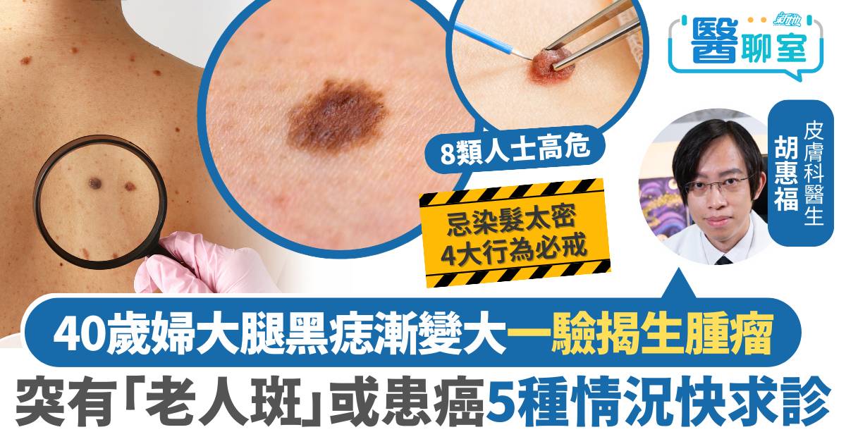 皮膚癌｜40歲婦大腿黑痣漸大揭為腫瘤 突生「老人斑」或為皮膚癌 染髮太密等4大高危行為必戒