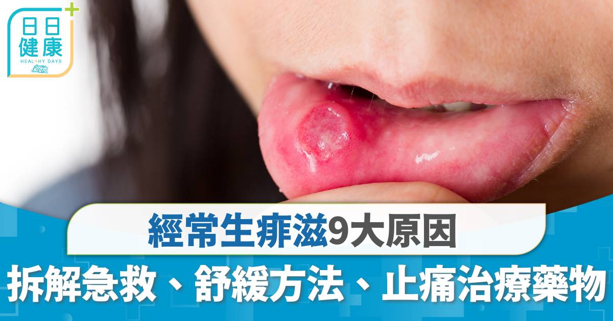 痱滋｜經常生痱滋9大原因 拆解急救、舒緩方法、痱滋膏等止痛治療藥物