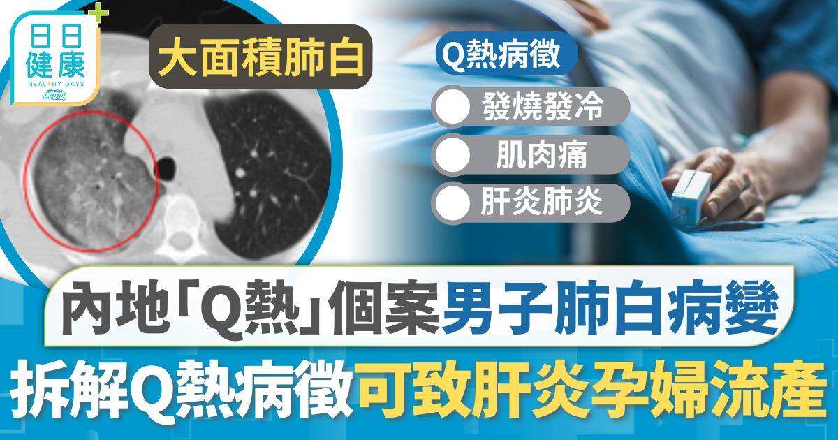 內地現罕見傳染病「Q熱」個案 男子回國後雙肺大面積病變 拆解病徵可致嚴重肝炎