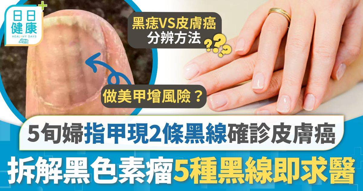 指甲現2條黑線確診皮膚癌 5旬婦切除拇指肉保命 拆解黑色素瘤5種黑線恐患癌