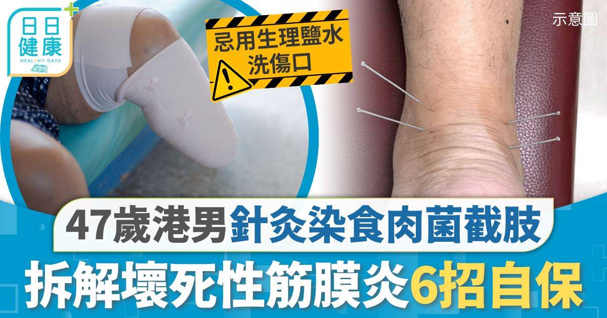 47歲港男搬重物扭傷 中醫針灸後染食肉菌截肢 拆解食肉菌感染6招自保