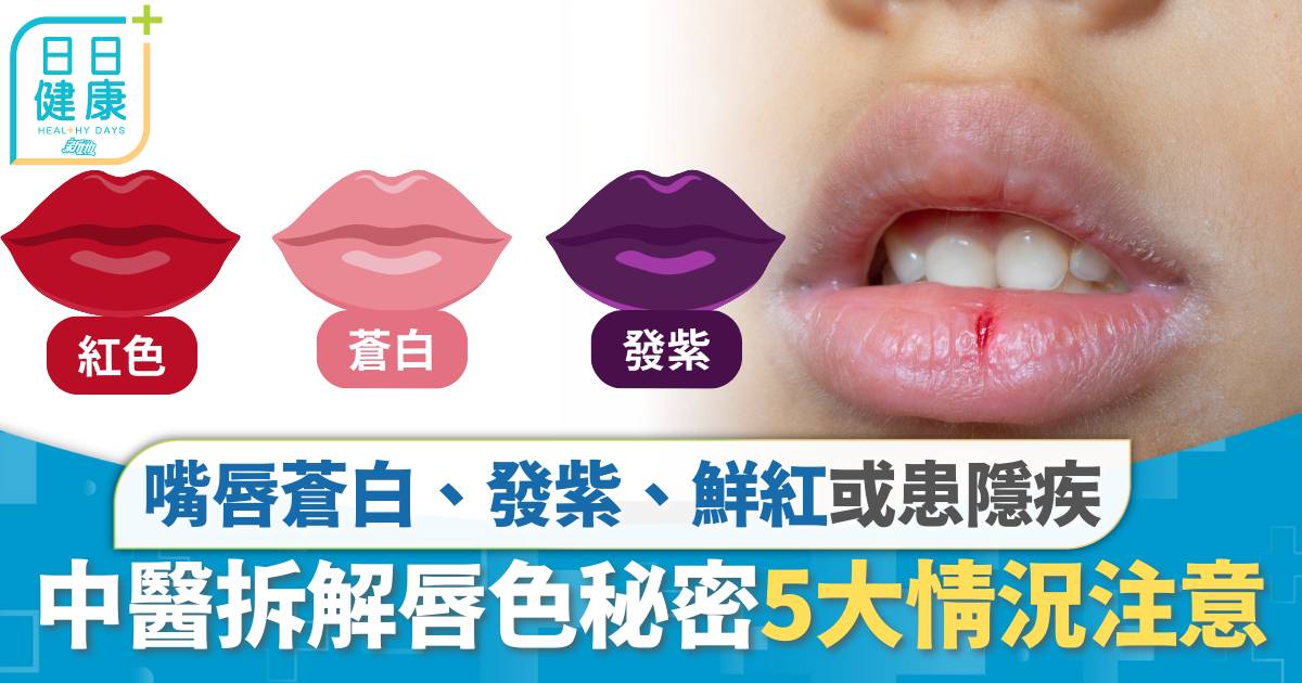 唇冇血色｜嘴唇蒼白、發紫、鮮紅或患隱疾 中醫拆解唇色健康秘密