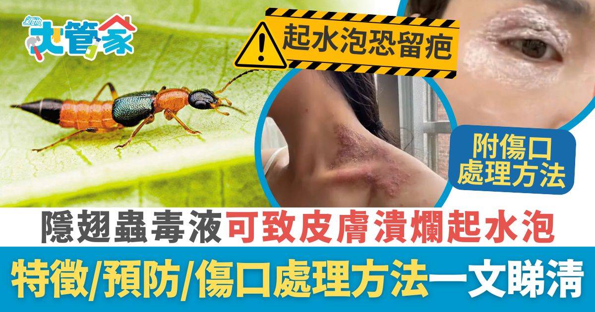 隱翅蟲 傷口處理 昆蟲出沒｜隱翅蟲有腐蝕性毒液 可致皮膚潰爛起水泡 隱翅蟲特徵／預防／傷口處理方法一文睇清