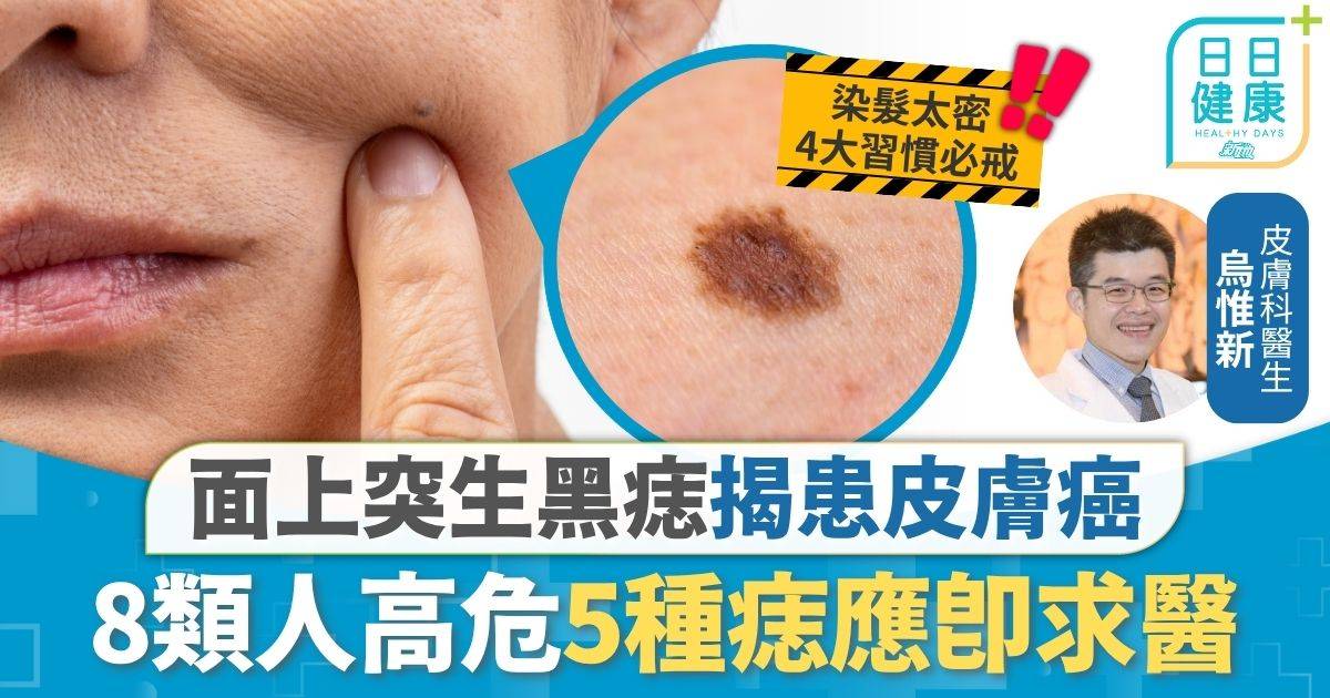 皮膚癌｜面上突生黑痣揭患皮膚癌 50歲以上現「黑班」勿忽略 8類人高危5種痣應即求醫