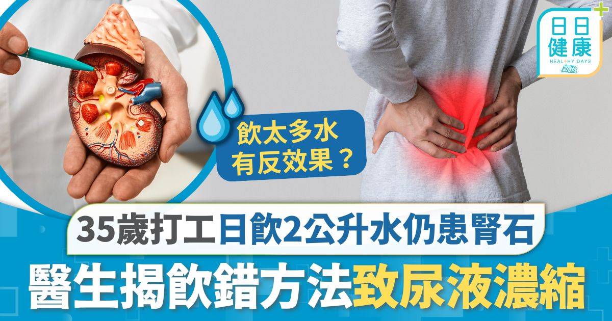 腎結石 腰痛 腎結石｜35歲打工仔腰部劇痛 日飲2公升水仍患腎石 醫生揭飲錯方法致尿液濃縮