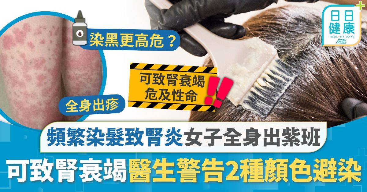 染髮 腎炎 染髮危機｜女子頻繁染髮致腎炎 全身出紫班屙啡色尿 醫生警告2種顏色避染