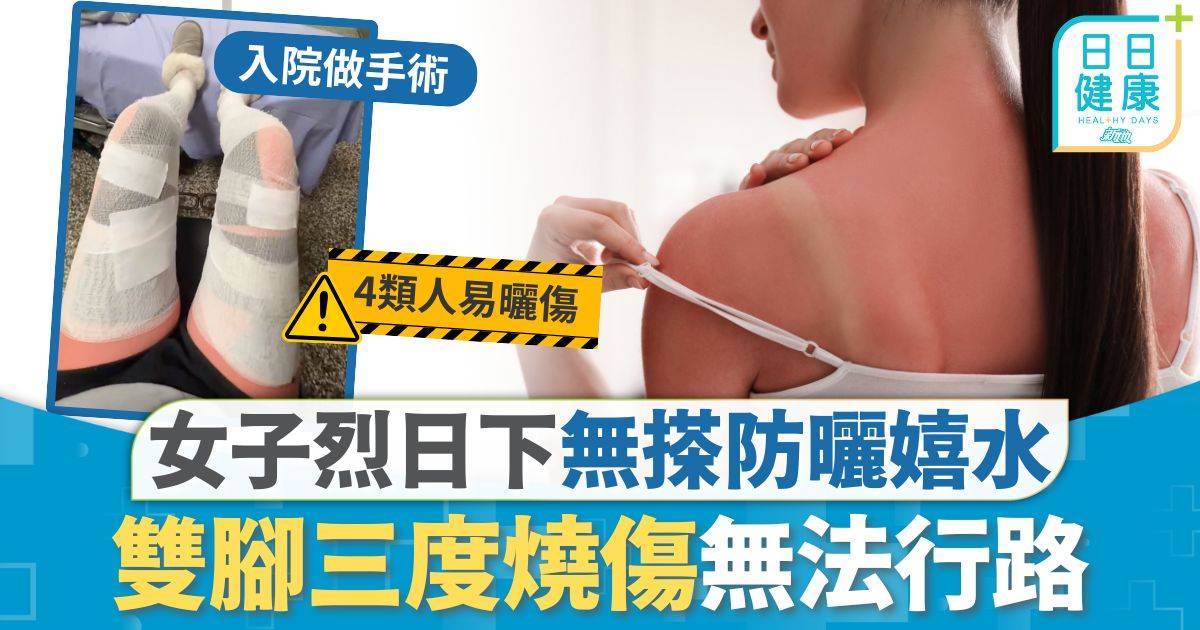戶外防曬｜女子烈日下無搽防曬嬉水 雙腳三度燒傷無法行路 6大防曬貼士忌與蚊怕水混用