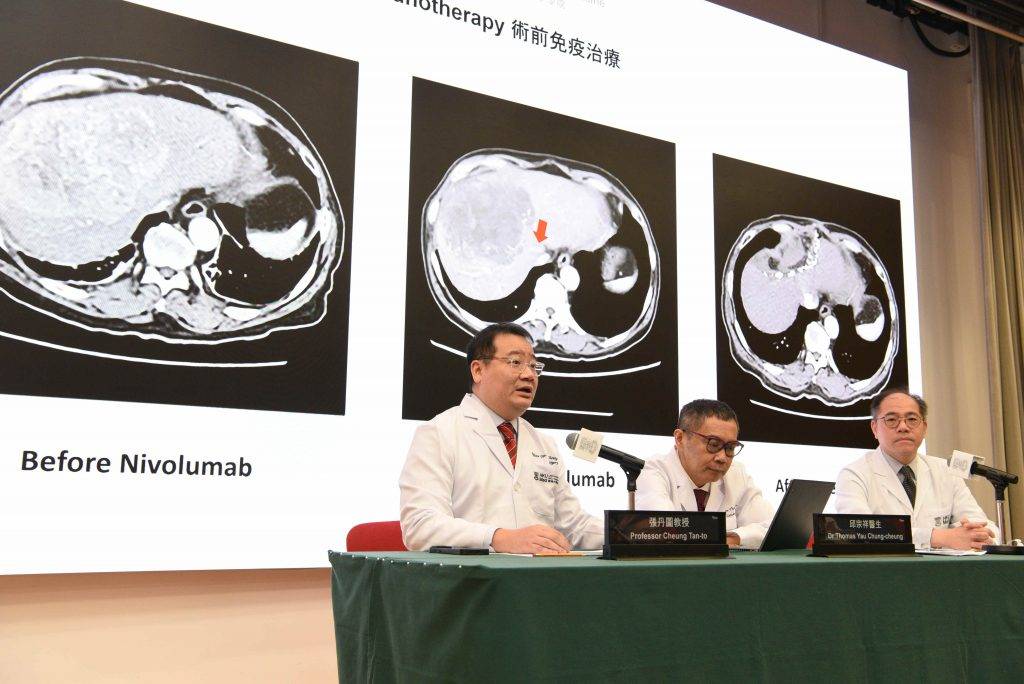 肝癌 隨著「雙重免疫療法組合」效果顯著,新組合治療已獲得FDA、EMA和NMPA批准用於未接受過醫治的晚期肝癌。研究團隊包括(左起)張丹圖教授、邱宗祥醫生及梁澄宇醫生。(圖片來源:港大醫學院)
