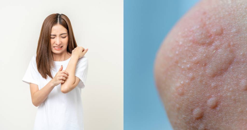 【風癩急救】突然出風癩又痕又腫？中醫教你5大即時止痕方法預防及食療全攻略