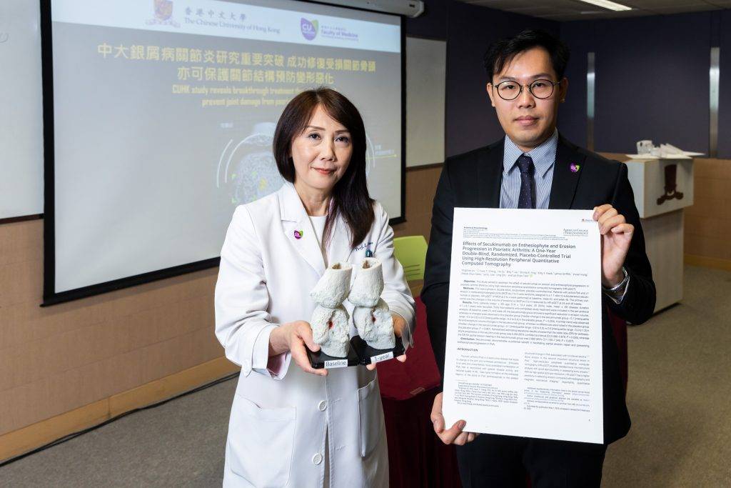 銀屑病 中大醫學院研究發現,銀屑病關節炎患者透過抑制炎症因子「白介素-17」,可以修復部分已侵蝕的骨頭和預防異常骨質增生,保護關節結構預防變形惡化。圖為中大醫學院內科及藥物治療學系講座教授及風濕科主管譚麗珊教授(左)及博士後研究員鄭梓灝博士。(圖片來源:中大圖片)