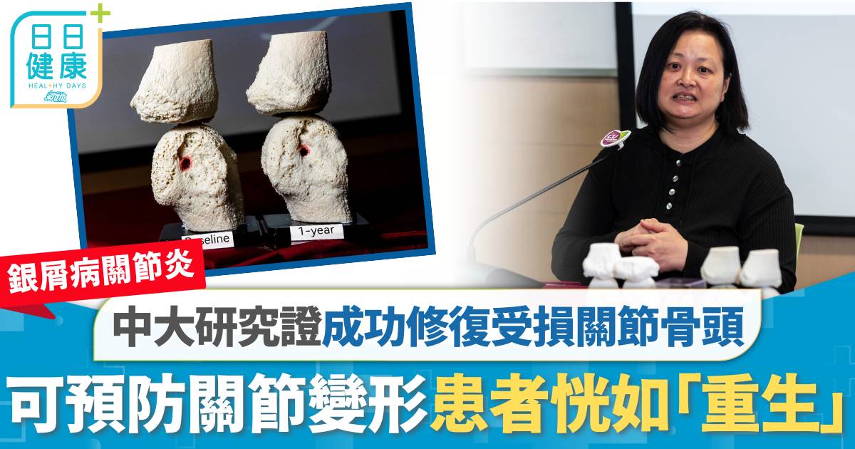 銀屑病關節炎｜中大研究證成功修復受損關節骨頭 可保護關節結構預防變形惡化