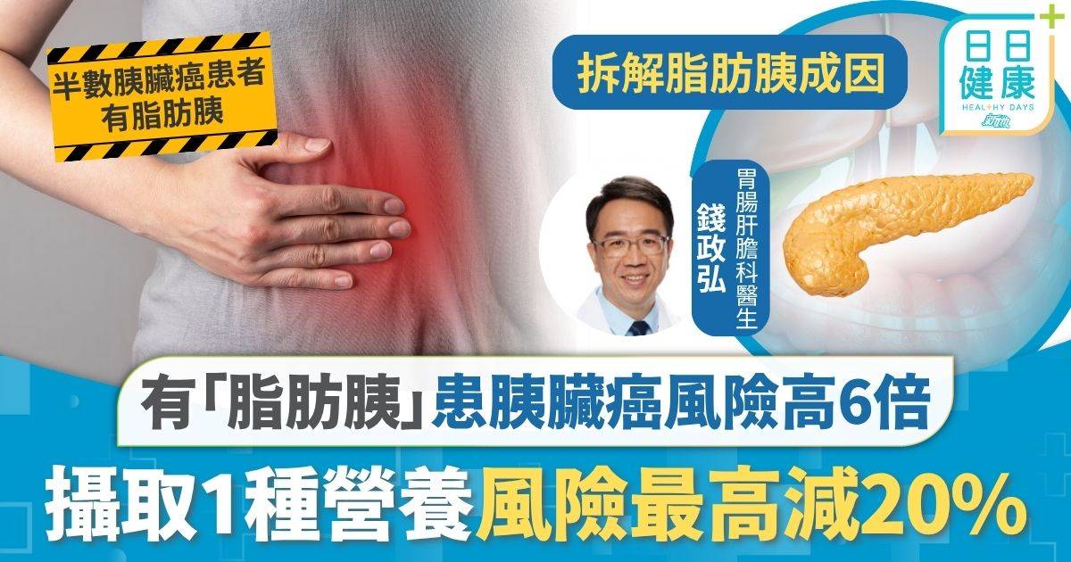胰臟癌｜有「脂肪胰」患胰臟癌風險高6倍 攝取1種營養風險最高減20% 6類人易有脂肪胰港人易中招
