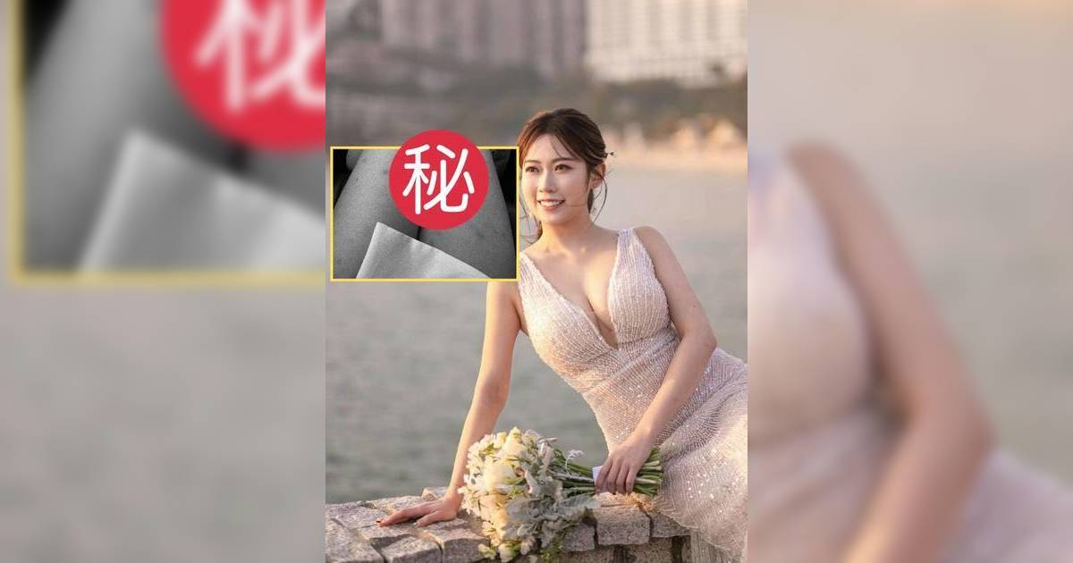 27歲TVB咪神自爆「玻璃娃娃」體質 滿腿瘀傷照片曝光 網民心痛