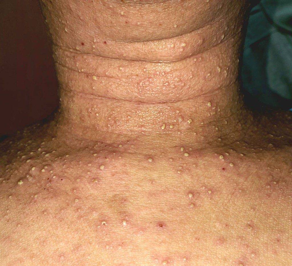 現年25歲的郭先生自中學起受濕疹困擾，應考DSE時病情更如火山爆發般惡化，被迫停學、求職屢受歧視。（圖片來源：濕疹關注組）