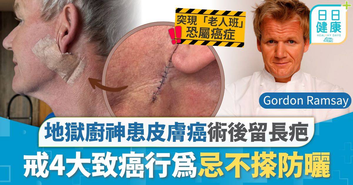 皮膚癌｜地獄廚神Gordon Ramsay患皮膚癌留巨疤 戒4大致癌行為忌不搽防曬 8類人高危醫生教1招自測