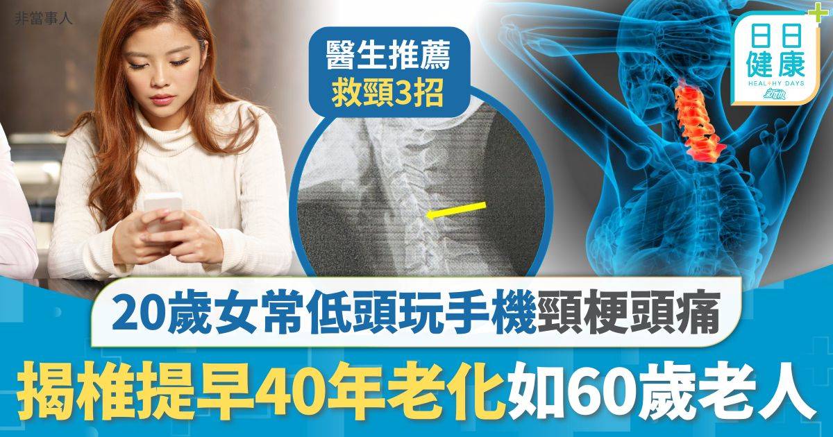 手機頸｜低頭玩手機致頸梗頭痛 20歲女頸椎退化如60歲 姿勢不良頸椎承重可達59磅