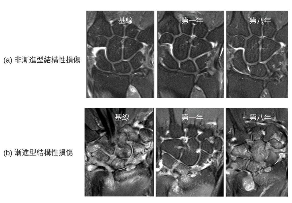 類風濕關節炎 中大醫學院對類風濕關節炎患者進行全球有史以來歷時最長的磁力共振研究,首次發現非漸進型及漸進型結構性損傷。此發現顯示MRI比X光檢查更有效識別結構性損傷,有助及早預測患者八年內出現關節嚴重變形及殘障的風險。(圖片來源:中大醫學院)
