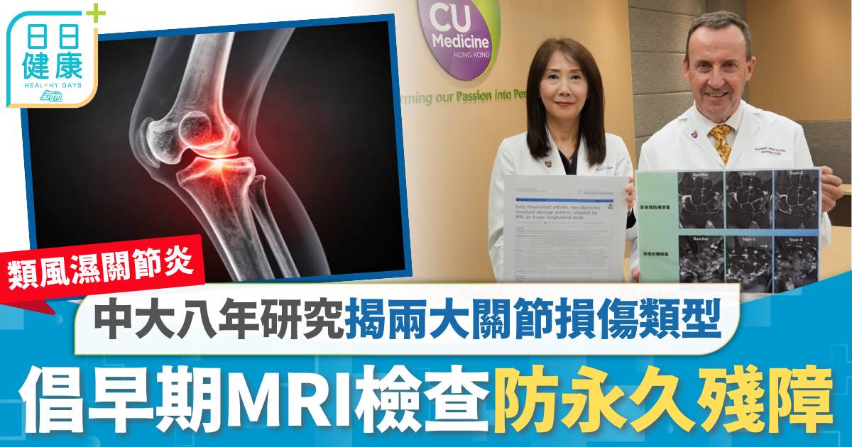 類風濕關節炎｜中大八年追蹤研究揭兩大關節損傷類型　倡早期MRI檢查防永久殘障