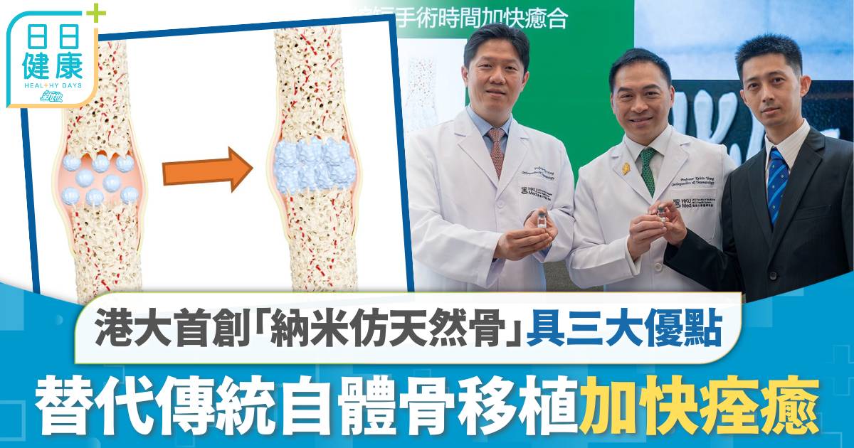 港大首創「納米仿天然骨」 具三大優點 替代傳統自體骨移植加快痊癒