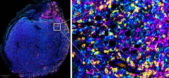 癌症免疫數據引擎 AOAH可以單獨發揮作用,亦能與現有免疫療法結合,產生協同效應,促進CD8+ T細胞和CD11c+樹突狀細胞的浸潤與激活,從而增強癌症免疫治療效果。(圖片來源:港大醫學院)