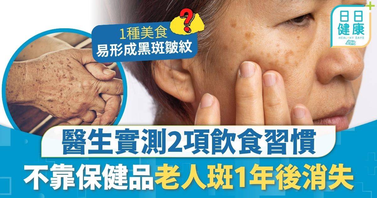 老人斑｜40歲起易有老人斑 醫生實測2項習慣改變 不靠保健品黑斑1年後消失