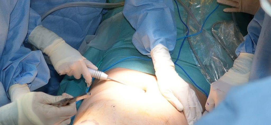 此項臨床試驗在乳房保留手術中即時結合自體脂肪移植技術重塑乳房，該技術從患者身體脂肪較多的部位抽取脂肪，經處理後再注射至乳房。（圖片來源：港大醫學院）