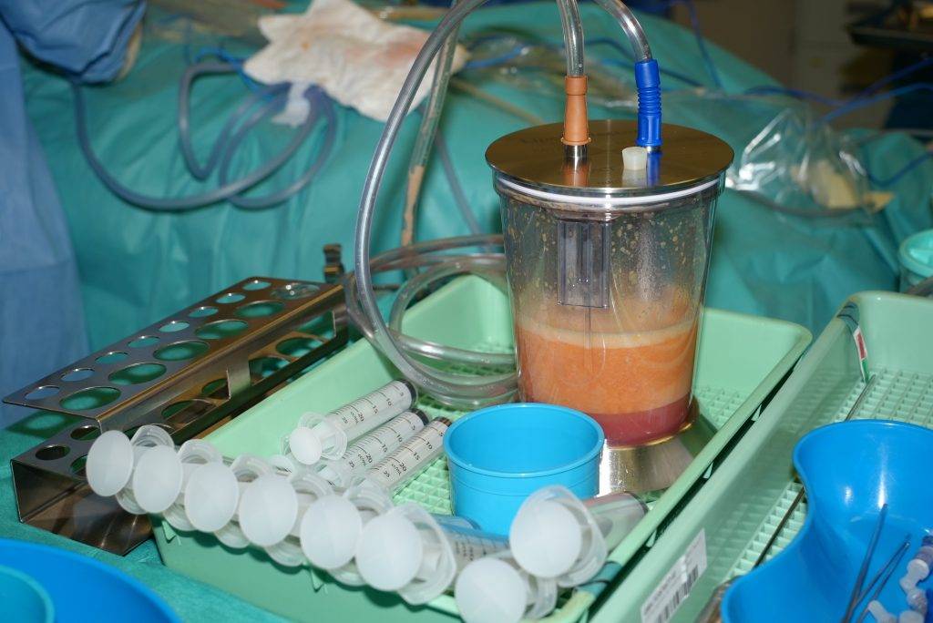 此項臨床試驗在乳房保留手術中即時結合自體脂肪移植技術重塑乳房，該技術從患者身體脂肪較多的部位抽取脂肪，經處理後再注射至乳房。（圖片來源：港大醫學院）