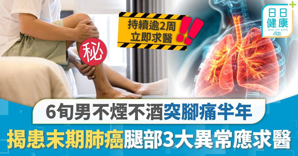 肺癌｜6旬男不煙不酒無大病 腳痛半年揭患末期肺癌 醫生警告腿部3大異常應即求醫
