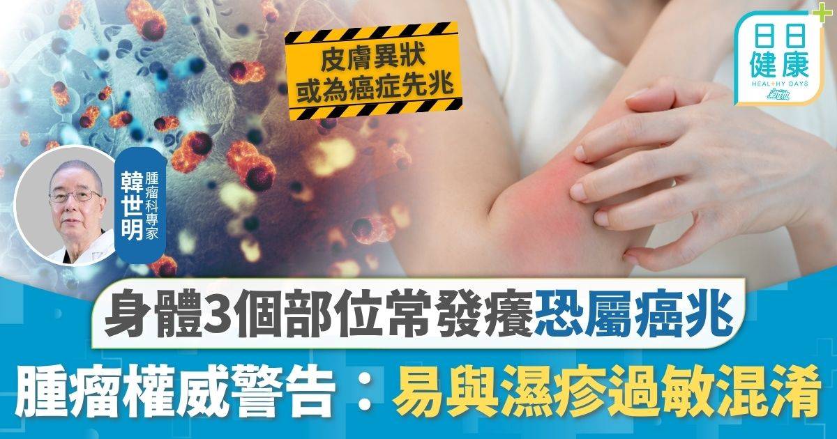 癌症病徵｜ 身體3個部位常發癢恐屬癌兆 鼻痕+3種情況或屬鼻咽癌 腫瘤權威警告：易與濕疹過敏混淆