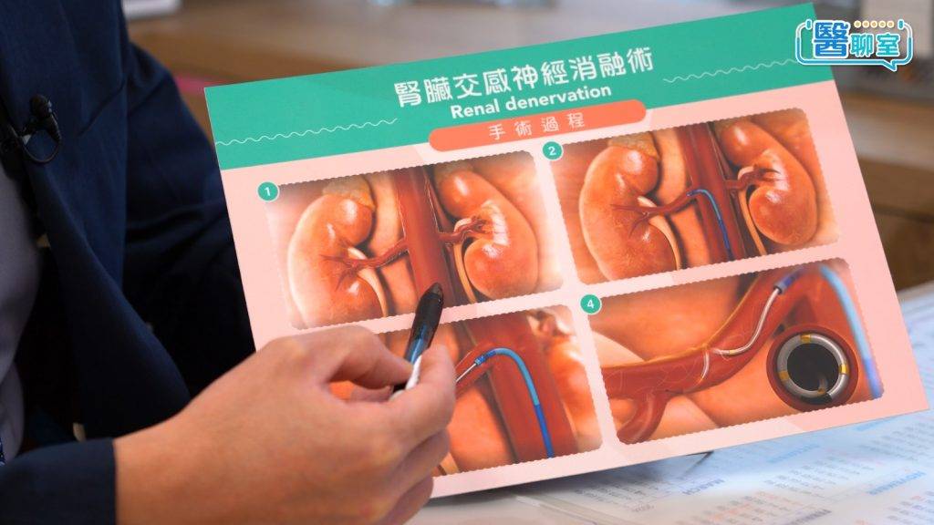 頑固性高血壓 陳杰醫生稱,腎交感神經消融手術(RDN)屬微創介入性治療,過程類似心導管手術。(圖片來源:日日健康)