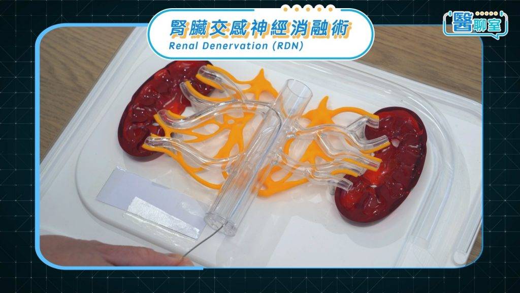 頑固性高血壓 醫生會在病人大腿腹股溝的股動脈穿刺導管,經導絲引導進入腎動脈分支。(圖片來源:日日健康)