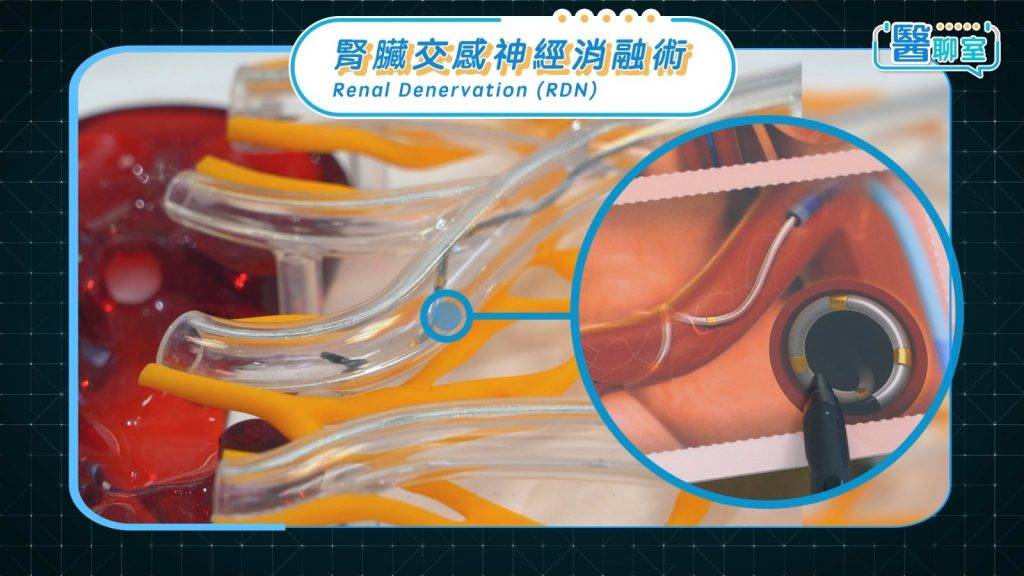 頑固性高血壓 導管末端設有四個金屬電極,透過環狀射頻能量進行「消融」,以阻斷腎動脈周邊過度活躍的交感神經。(圖片來源:日日健康)