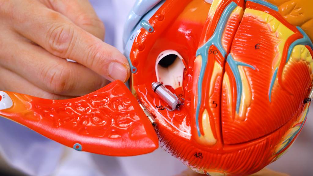 心跳過慢 植入無導線起搏器時會在大腿位置的股靜脈開一個小傷口,利用導管沿靜脈把整粒起搏器送入心臟。(圖片來源:日日健康)