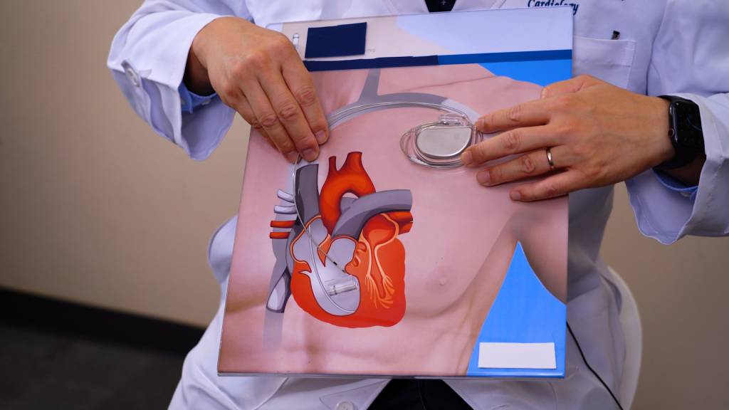 心跳過慢 傳統起搏器需將主機放入皮下「囊袋」,然後經靜脈把電線延至心臟。(圖片來源:日日健康)