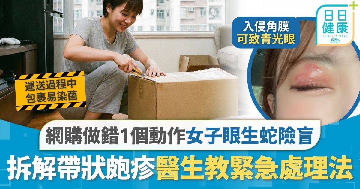 帶狀皰疹｜網購開箱做錯1個動作 27歲女眼部生蛇險盲 拆解帶狀皰疹醫生教緊急處理法