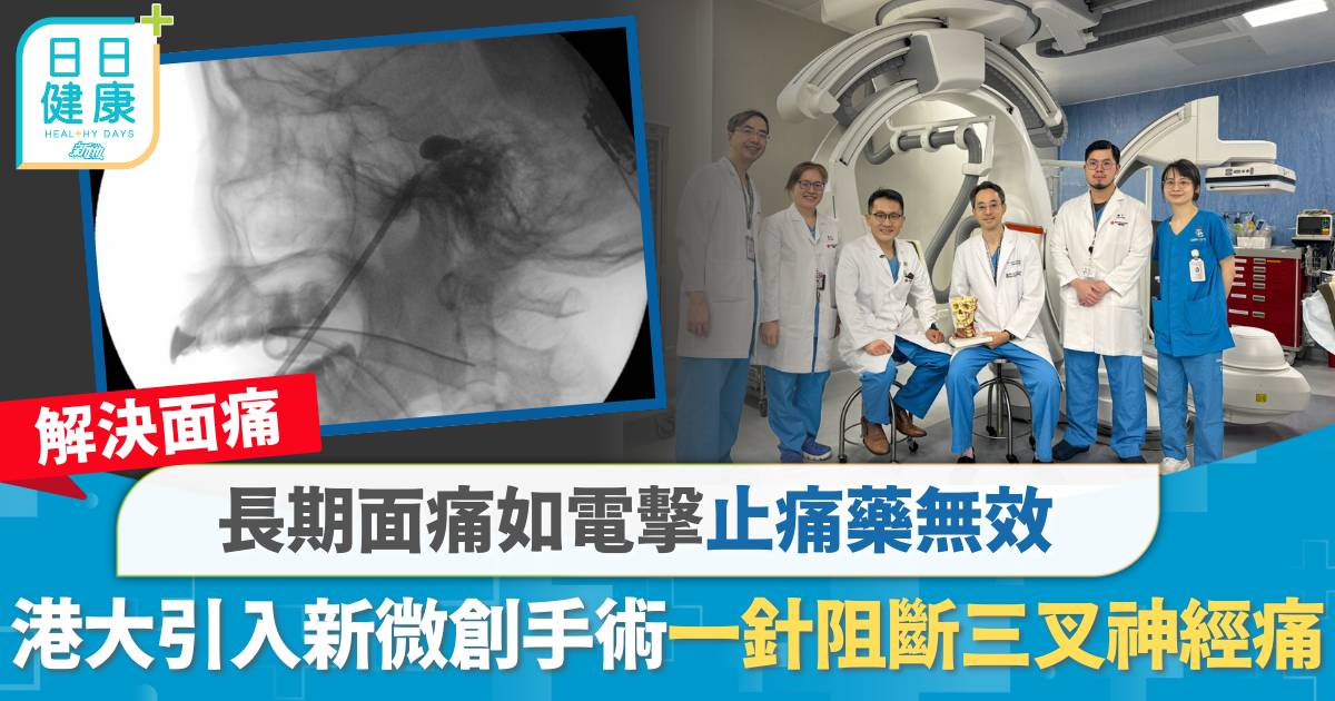 長期面痛如電擊止痛藥無效　港大引入新微創手術　一針阻斷三叉神經痛