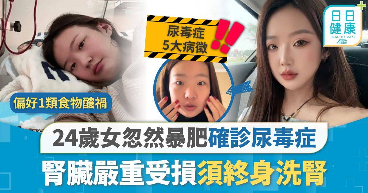 尿毒症｜24歲女忽然暴肥節食減磅 半年減50磅驚患尿毒症 腎臟嚴重受損須終身洗腎